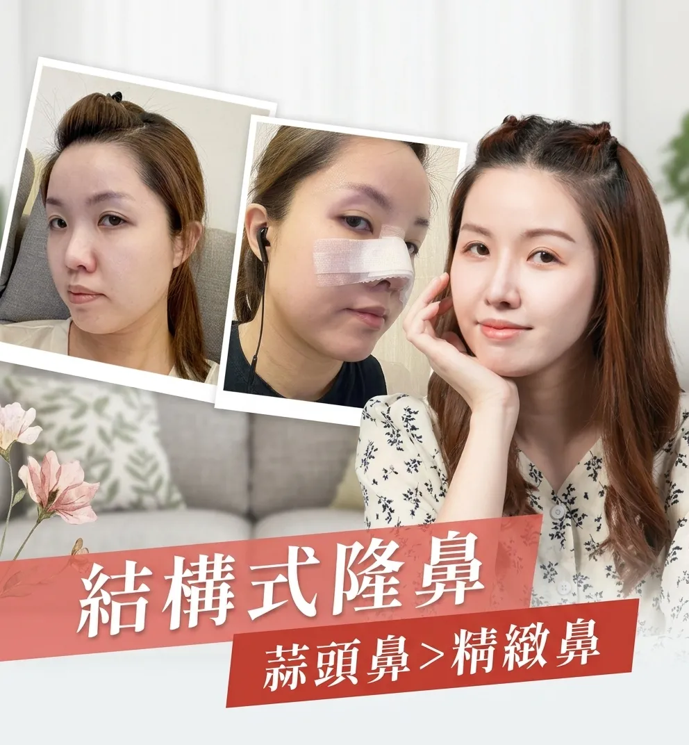 隆鼻-隆鼻手術-結構式隆鼻-韓式隆鼻-隆鼻推薦