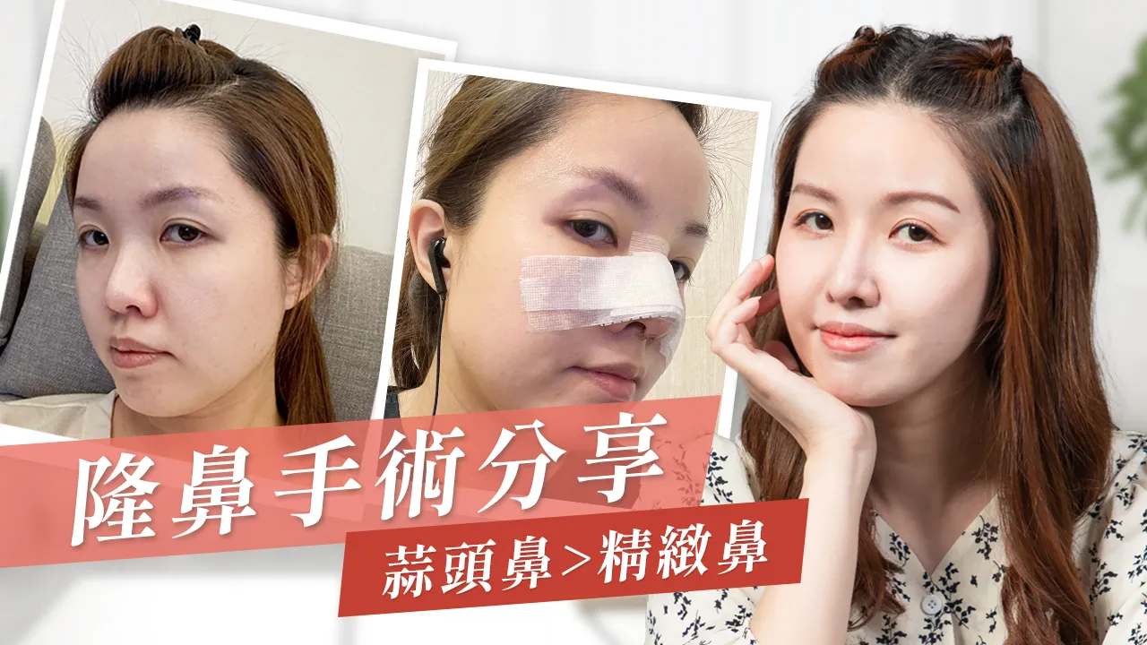 隆鼻-隆鼻手術-結構式隆鼻-韓式隆鼻-隆鼻推薦