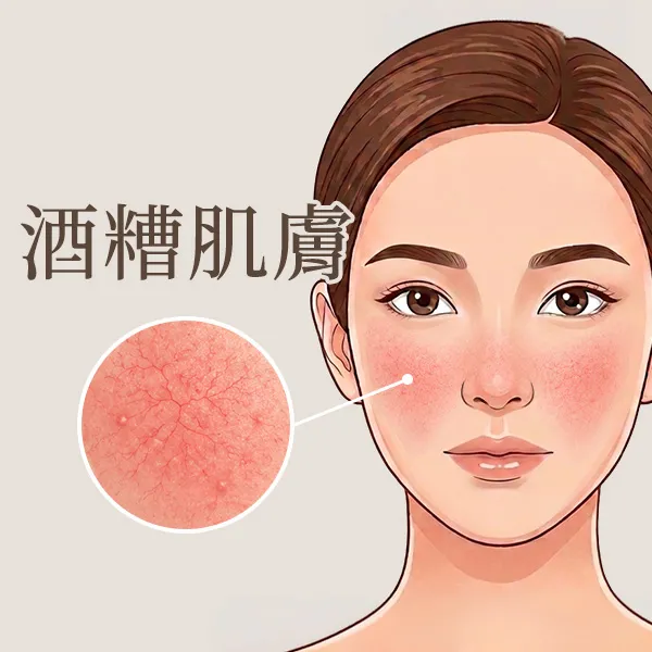 酒糟肌膚