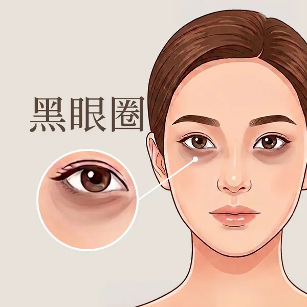 黑眼圈