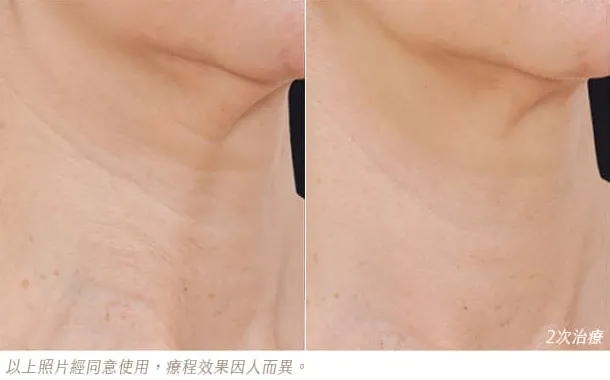 profhilo治療前後對比照-profhilo效果-profhilo醫美推薦-profhilo醫美