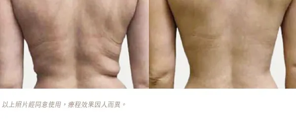ONDA PRO腰側超微波體雕-肌膚緊實