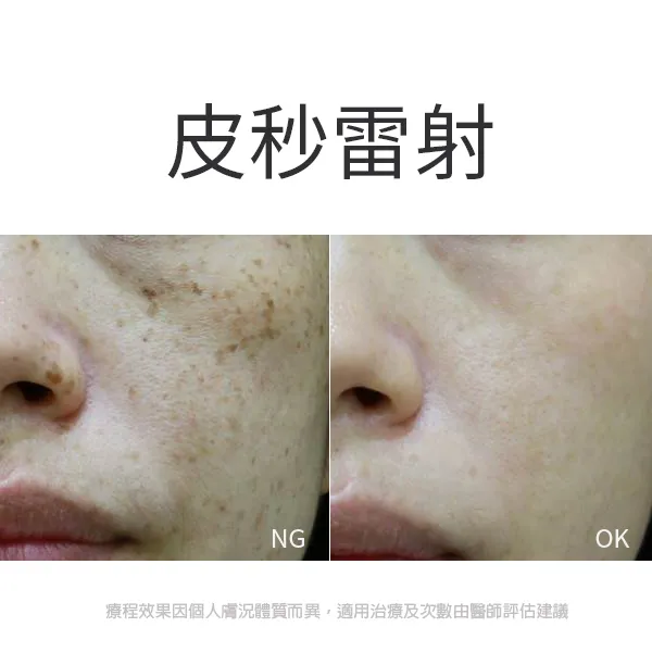 皮秒雷射改善效果前後比對