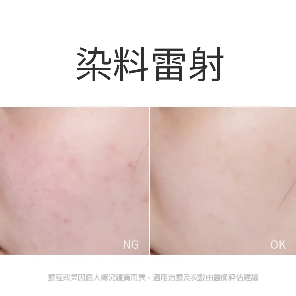 臻顏診所染料雷射術前術後比對