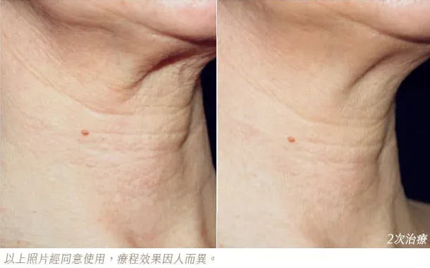 profhilo治療前後對比照-profhilo效果-profhilo醫美推薦-profhilo醫美