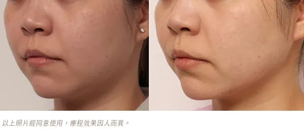 ONDA PRO雙下巴拉提