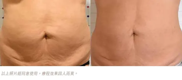ONDA PRO昂達超微波腹部減脂