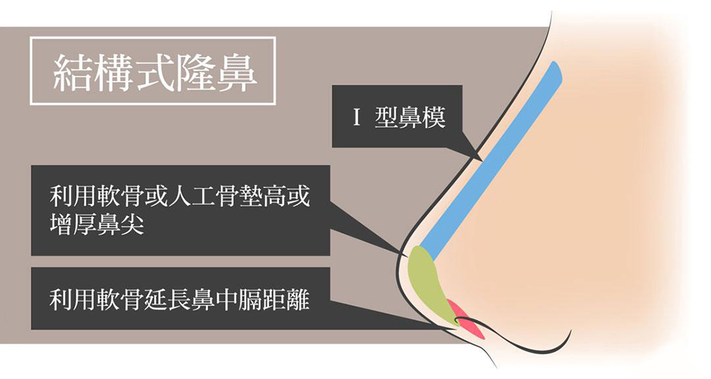 結構式隆鼻與傳統隆鼻分段雕塑解剖構造差異對比圖-隆鼻手術推薦
