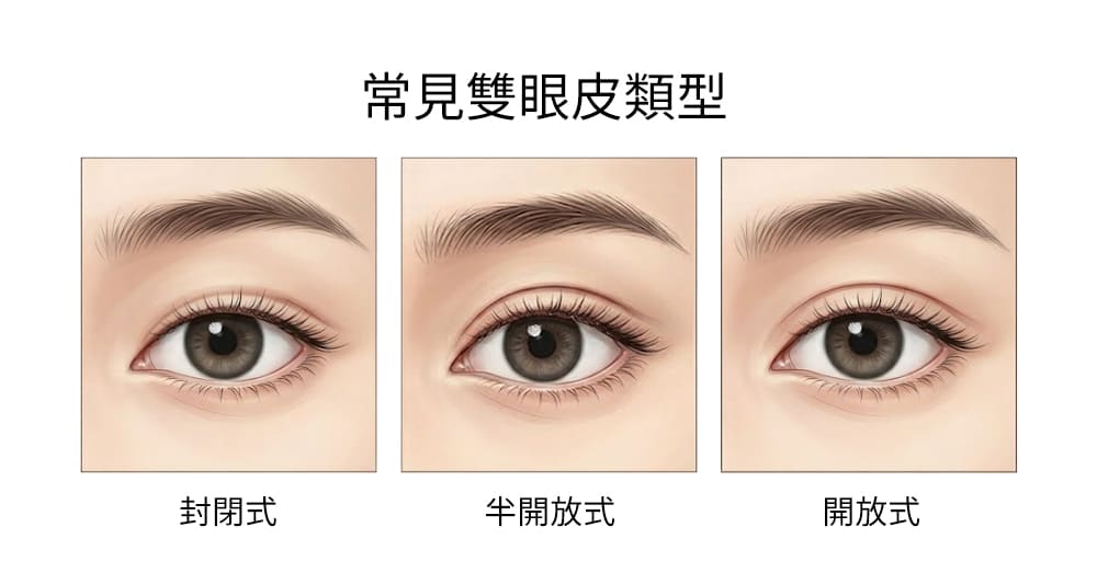 雙眼皮類型-開放式雙眼皮-封閉式雙眼皮-半開放式雙眼皮