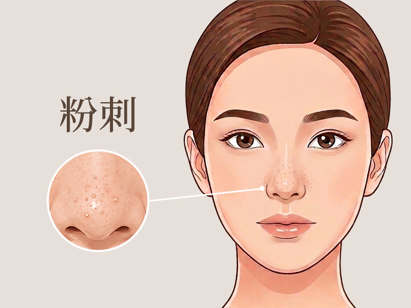 粉刺治療-粉刺怎麼清-黑頭粉刺-白頭粉刺-粉刺形成原因-清粉刺