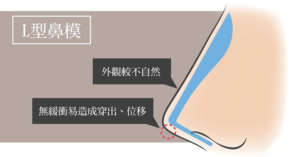 結構式隆鼻與傳統隆鼻差異