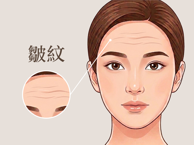 皺紋-除皺-消除皺紋-醫美除皺-皺眉紋-抬頭紋-法令紋