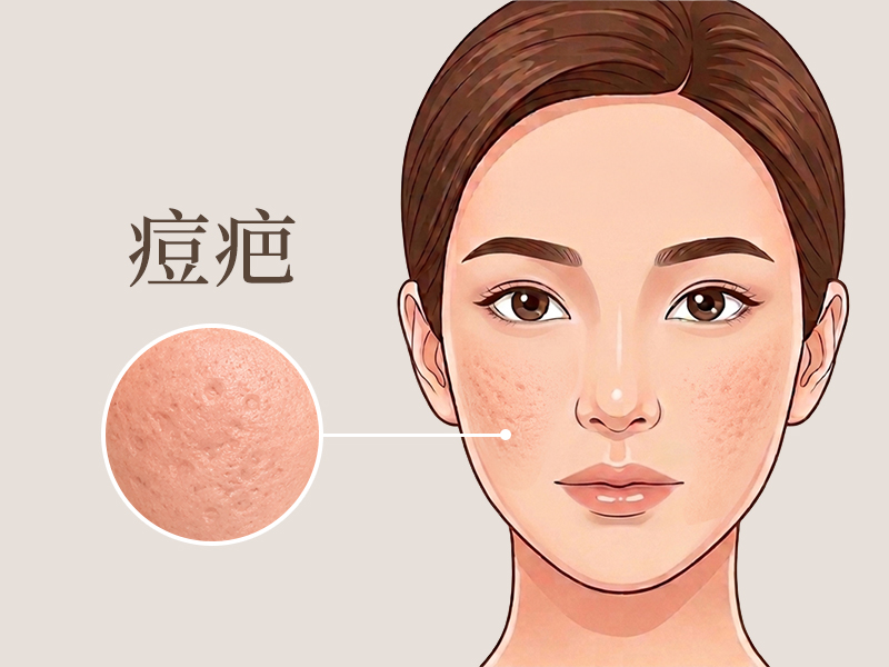 痘疤治療-痘疤雷射-凹洞痘疤-痘疤-痘疤消除-痘疤醫美-痘疤怎麼消-痘疤皮秒雷射-痘疤飛梭雷射