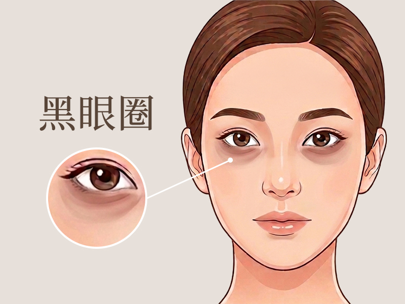 黑眼圈-黑眼圈治療-黑眼圈醫美-黑眼圈雷射-淚溝黑眼圈-眼周暗沉-黑眼圈原因-黑眼圈消除